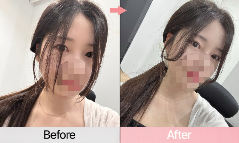 눈솔 비포 애프터 (1).png